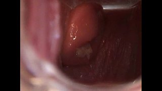 Avy פתח הכוס עם ספקולום